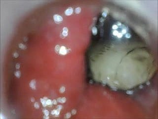 anal endoscope aggravation play from medial